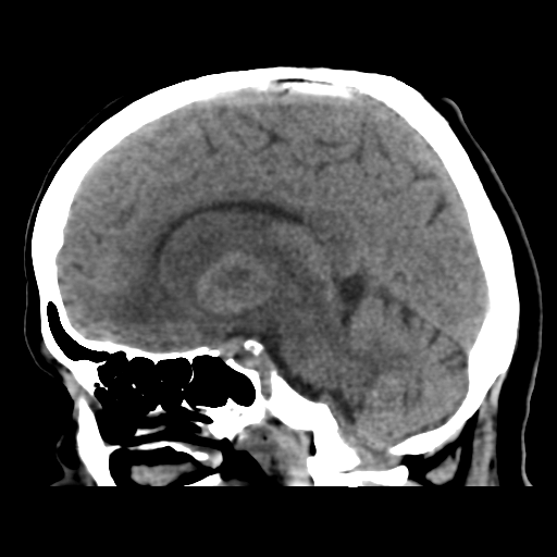 Cerebral metastasis to basal ganglia (Radiopaedia 81568-95412 E 29).png