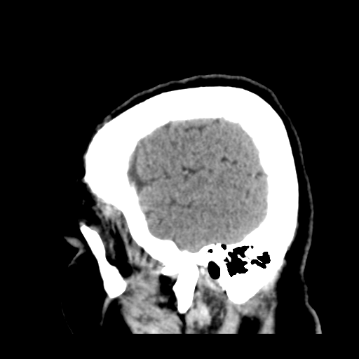 Cerebral metastasis to basal ganglia (Radiopaedia 81568-95412 Sagittal C+ delayed 48).png