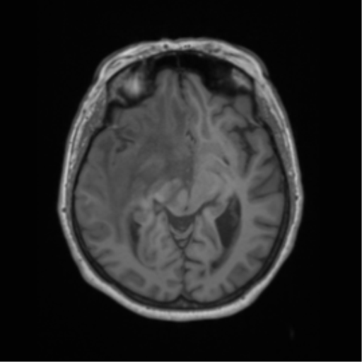 Cerebral metastasis to basal ganglia (Radiopaedia 81568-95413 Axial T1 31).png