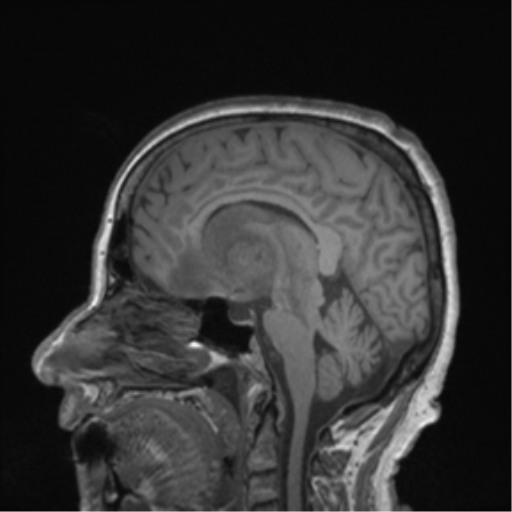 Cerebral metastasis to basal ganglia (Radiopaedia 81568-95413 Sagittal T1 39).png
