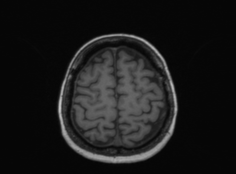 Cerebral ring enhancing lesions - cerebral metastases (Radiopaedia 44922-48817 Axial T1 140).jpg
