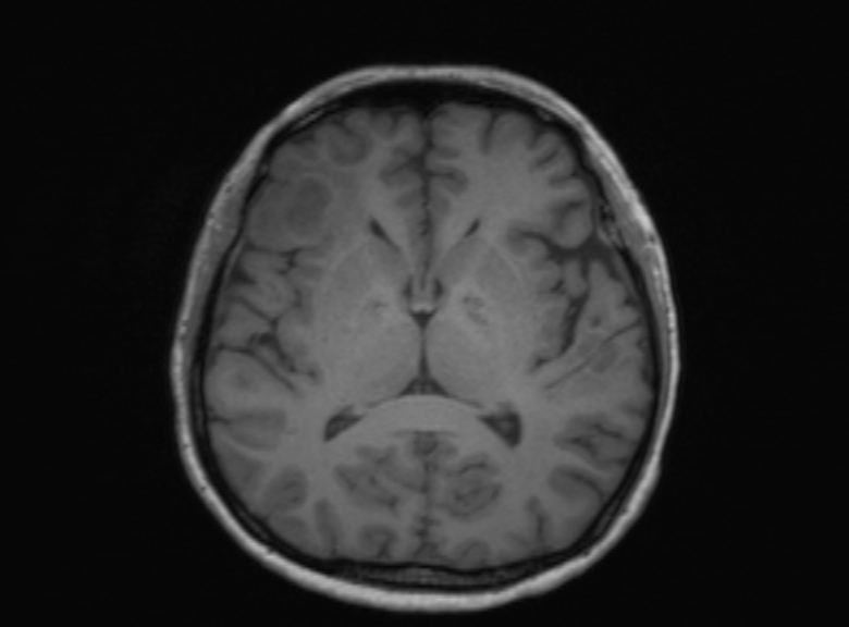 Cerebral ring enhancing lesions - cerebral metastases (Radiopaedia 44922-48817 Axial T1 222).jpg