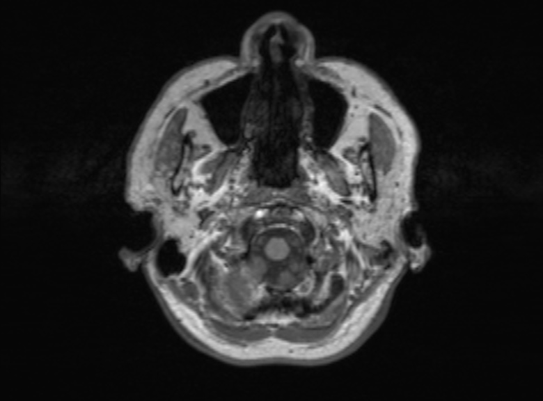Cerebral ring enhancing lesions - cerebral metastases (Radiopaedia 44922-48817 Axial T1 353).jpg
