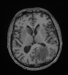 File:Cerebral toxoplasmosis (Radiopaedia 43956-47461 Axial T1 41).jpg