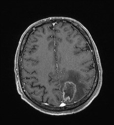 File:Cerebral toxoplasmosis (Radiopaedia 43956-47461 Axial T1 C+ 54).jpg