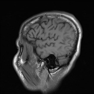File:Cerebral toxoplasmosis (Radiopaedia 43956-47461 Sagittal T1 18).jpg