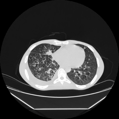 Cerebral tuberculoma (Radiopaedia 80829-94318 Axial lung window 115).jpg