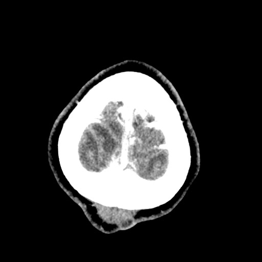 Cerebral tuberculosis with dural sinus invasion (Radiopaedia 60353-68019 Axial C+ delayed 63).jpg