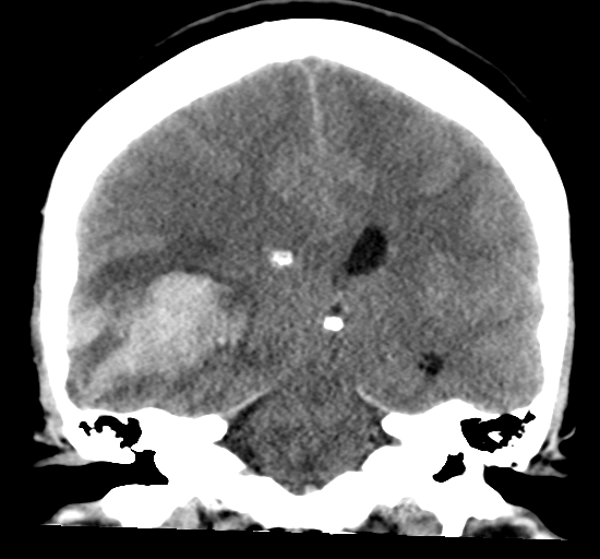 File:Cerebral venous infarct related to dural venous sinus thromboses (Radiopaedia 35292-36803 Coronal 23).png