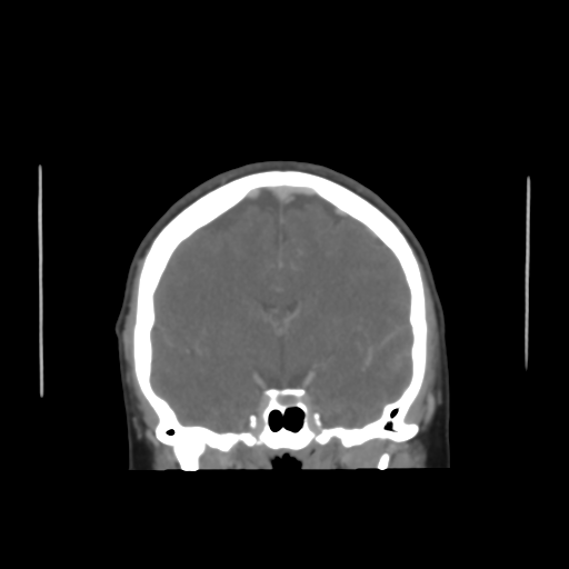Cerebral venous infarction due to transverse sinus thrombosis (Radiopaedia 34688-36120 Axial CT venogram 1).png