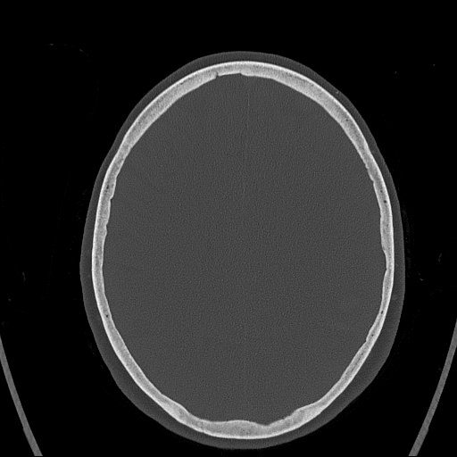 Cerebral venous infarction with hemorrhage (Radiopaedia 65343-74381 Axial bone window 123).jpg