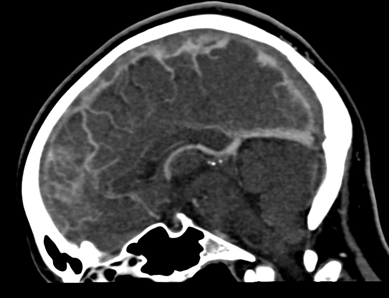 Cerebral venous sinus thrombosis (Radiopaedia 59224-66646 Sagittal C+ delayed 25).jpg