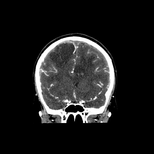 File:Cerebral venous throbmosis - hemorrhagic venous infarction (Radiopaedia 87318-103613 Coronal CT venogram 11).jpg