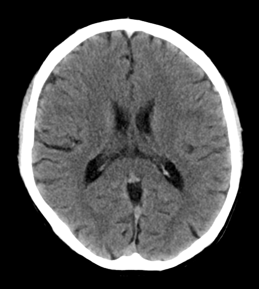 File:Cerebral venous thrombosis (Radiopaedia 38392-40467 Axial non-contrast 16).png