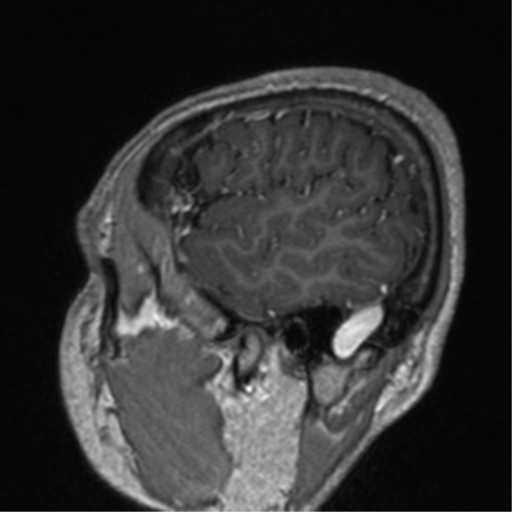 Cerebral venous thrombosis (Radiopaedia 38392-40469 Sagittal T1 C+ 17).png