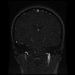 Cerebral venous thrombosis - ulcerative colitis (Radiopaedia 66049-75219 Coronal MRV 55).jpg