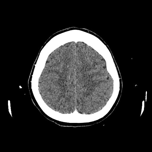 Cerebral venous thrombosis with venous hemorrhagic infarct (Radiopaedia 90354-107660 Axial with contrast 127).jpg