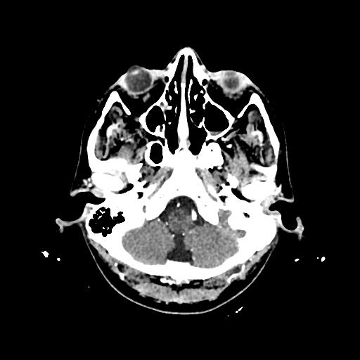 Cerebral venous thrombosis with venous hemorrhagic infarct (Radiopaedia 90354-107660 Axial with contrast 26).jpg