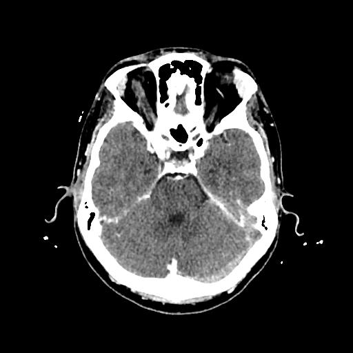 Cerebral venous thrombosis with venous hemorrhagic infarct (Radiopaedia 90354-107660 Axial with contrast 55).jpg