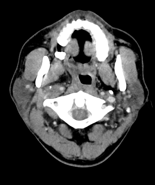 Cervical abscess (Radiopaedia 43725-47184 A 16).png