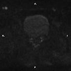 Cervical adenocarcinoma (Radiopaedia 65011-73985 Axial DWI 30).jpg