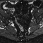 File:Cervical adenocarcinoma (Radiopaedia 65011-73985 Axial DWI 67).jpg
