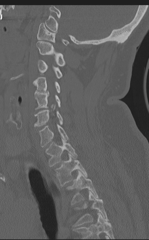 Cervical canal stenosis due to ossification of the posterior longitudinal ligament (Radiopaedia 47260-51823 Sagittal bone window 47).png