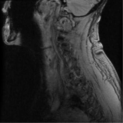 File:Cervical canal stenosis with cord compression (Radiopaedia 34114-35374 D 6).png