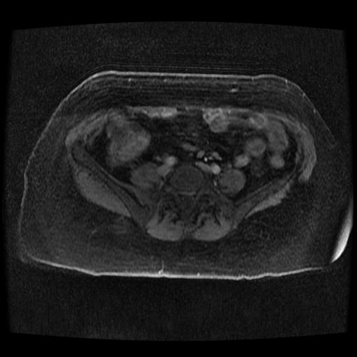 Cervical carcinoma (Radiopaedia 70924-81132 Axial T1 C+ fat sat 171).jpg