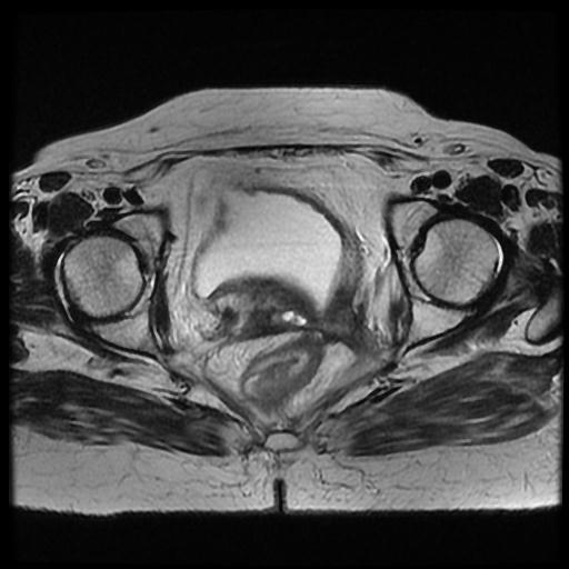 File:Cervical carcinoma (Radiopaedia 70924-81132 Axial T2 11).jpg