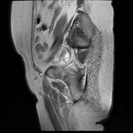 File:Cervical carcinoma (Radiopaedia 88010-104555 Sagittal T2 2).jpg