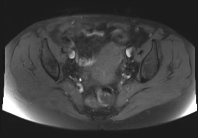 File:Cervical carcinoma (Radiopaedia 88312-104943 Axial T1 fat sat 11).jpg