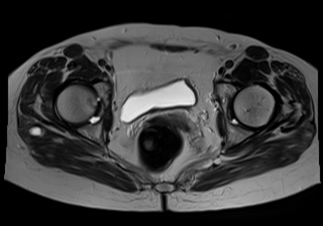 File:Cervical carcinoma (Radiopaedia 88312-104943 Sagittal T1 15).jpg