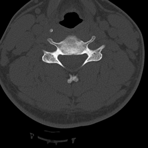 Cervical schwannoma (Radiopaedia 57979-64974 Axial bone window 27).png