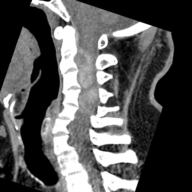 Cervical spinal neurofibroma in a patient with NF1 (Radiopaedia 58344-65464 C 28).jpg