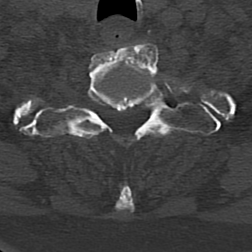 Cervical spine fracture - chalk stick (Radiopaedia 39116-41323 Axial bone window 78).png