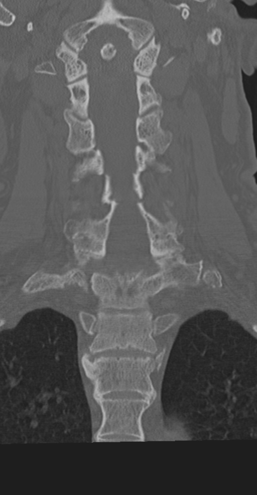 Cervical spine fracture in the setting of ankylosis (Radiopaedia 37038-38715 Coronal bone window 38).png