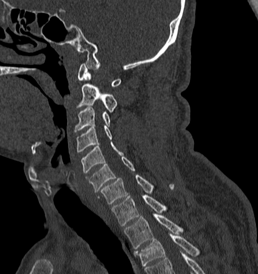File:Cervical spine trauma with tear drop fracture and perched facet joint (Radiopaedia 53989-60127 Sagittal bone window 62).jpg