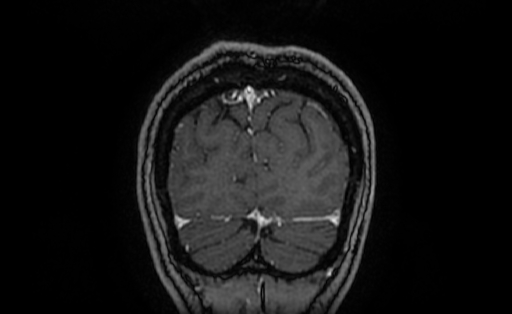 Cervical spondylodiscitis and calvarial hemangioma (Radiopaedia 64317-73103 Coronal T1 C+ 66).jpg