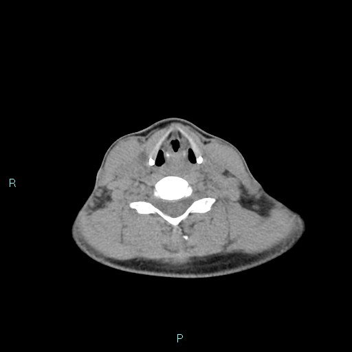 File:Cervical thymic cyst (Radiopaedia 88632-105335 Axial non-contrast 51).jpg