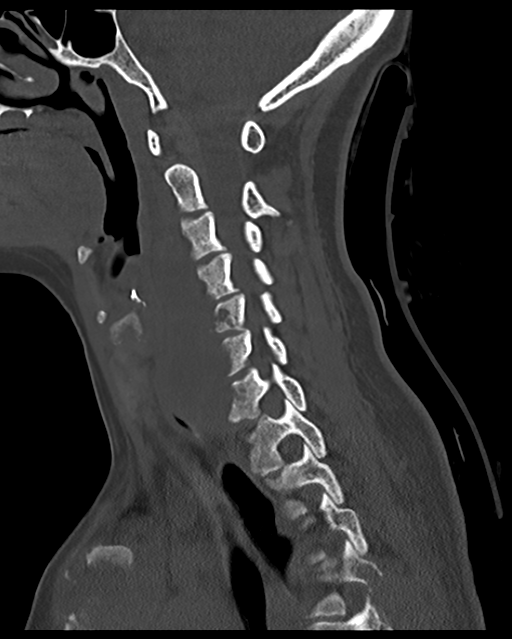 Cervical tuberculous spondylitis (Radiopaedia 39149-41365 Sagittal bone window 41).png