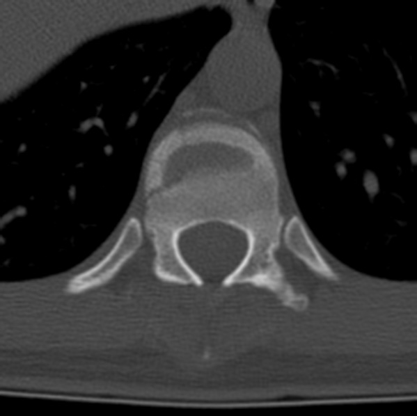 File:Chance fracture (Radiopaedia 36521-38081 Axial bone window 15).jpg