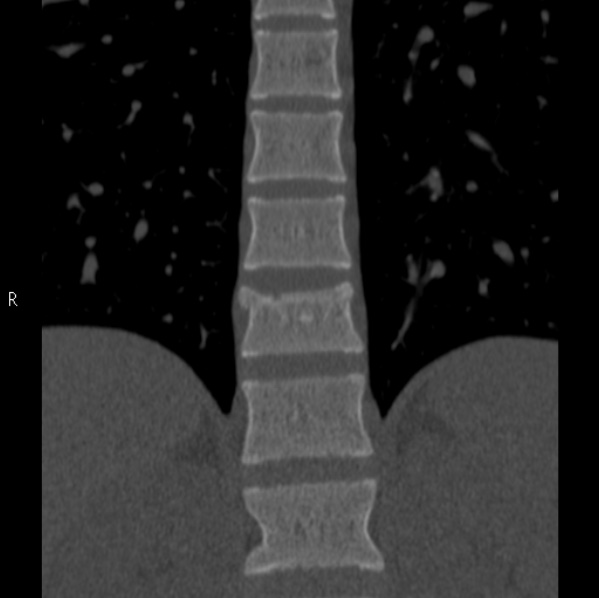 File:Chance fracture (Radiopaedia 36521-38081 Coronal bone window 16).jpg