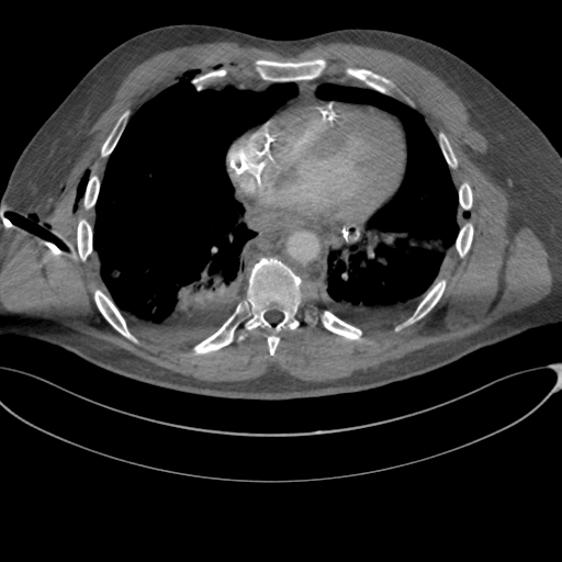 File:Chest multitrauma - aortic injury (Radiopaedia 34708-36147 A 190).png