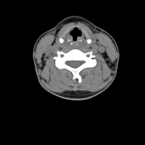File:Chiari I malformation and obstructive hydrocephalus (Radiopaedia 41185-43981 D 58).png