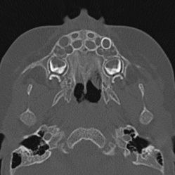 File:Choanal atresia (Radiopaedia 88525-105975 Axial bone window 15).jpg
