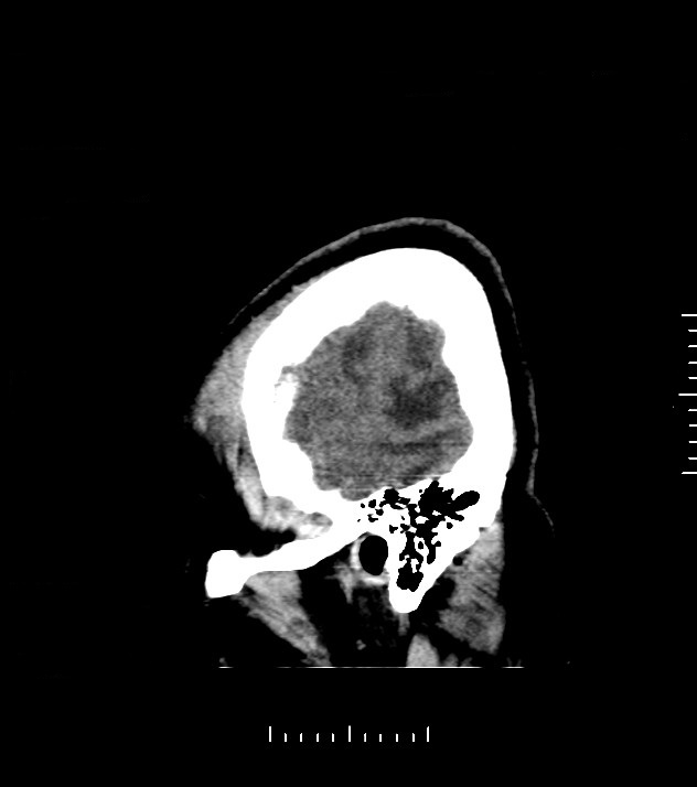 Cholangiocarcinoma with cerebral metastases (Radiopaedia 83519-98628 C 3).jpg