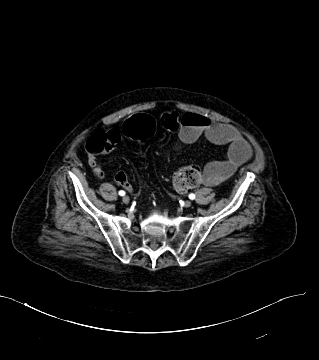 Cholangiocarcinoma with cerebral metastases (Radiopaedia 83519-98629 B 95).jpg