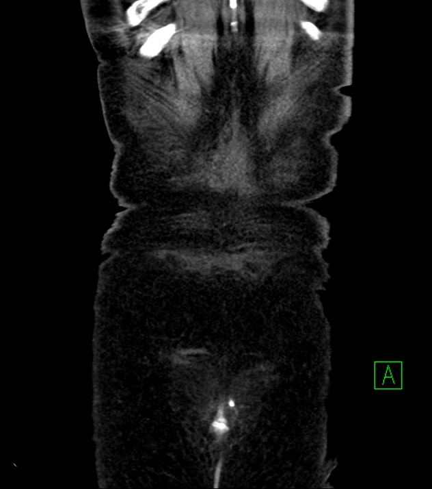 Cholangiocarcinoma with cerebral metastases (Radiopaedia 83519-98629 E 85).jpg