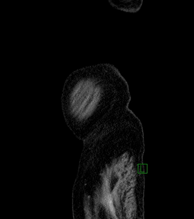 Cholangiocarcinoma with cerebral metastases (Radiopaedia 83519-98629 F 115).jpg